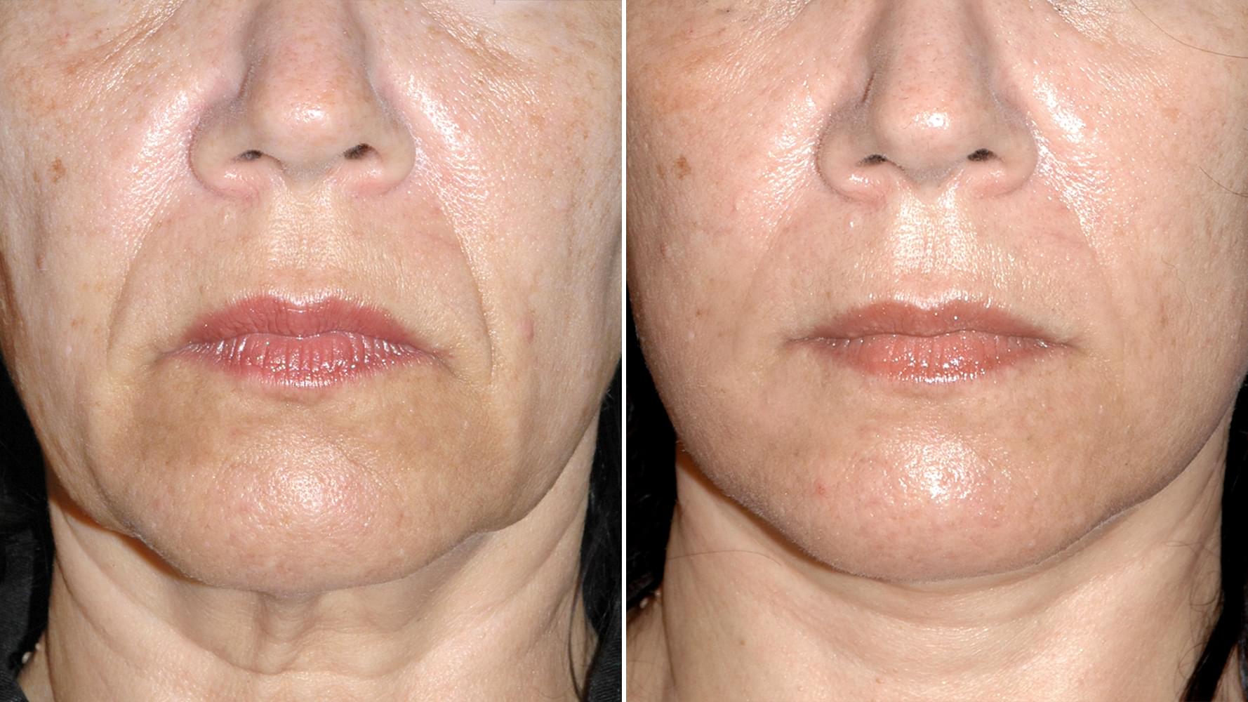 Antes e depois Micro-lift