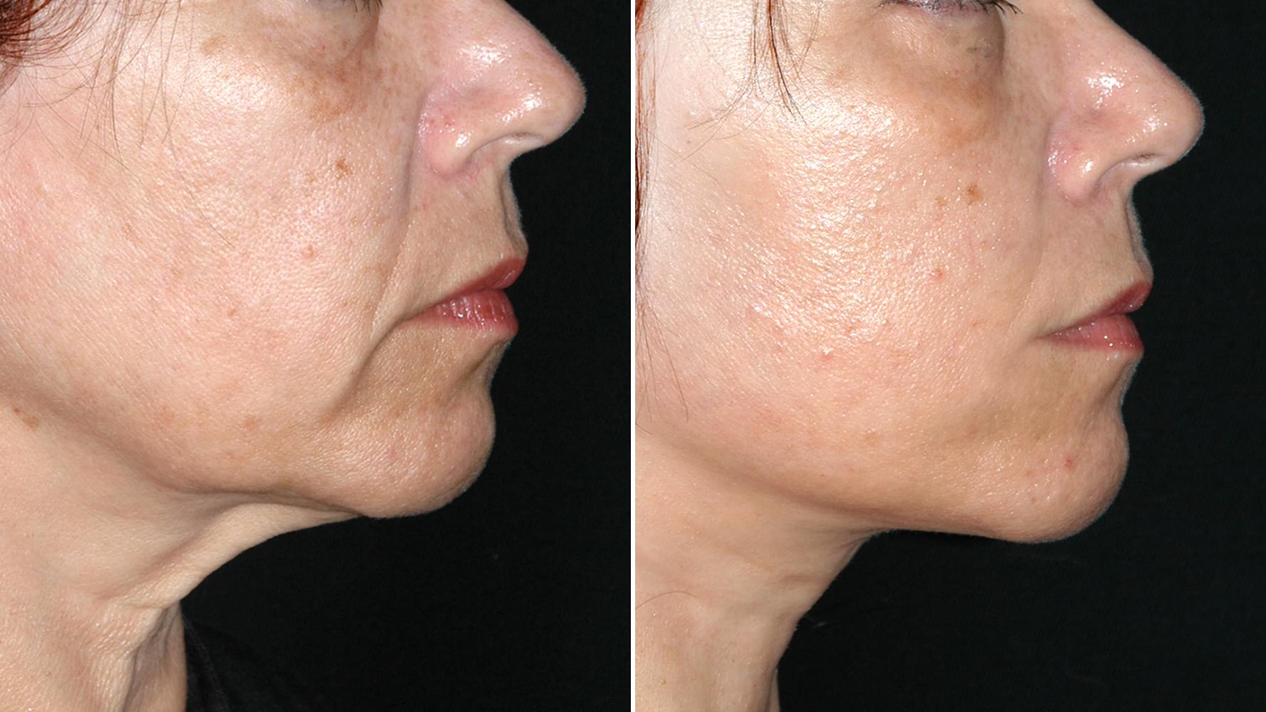 Antes e depois Micro-lift