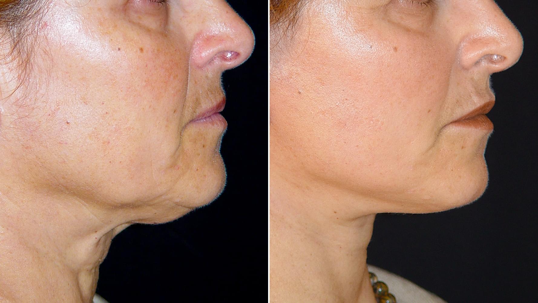 Antes e depois Micro-lift