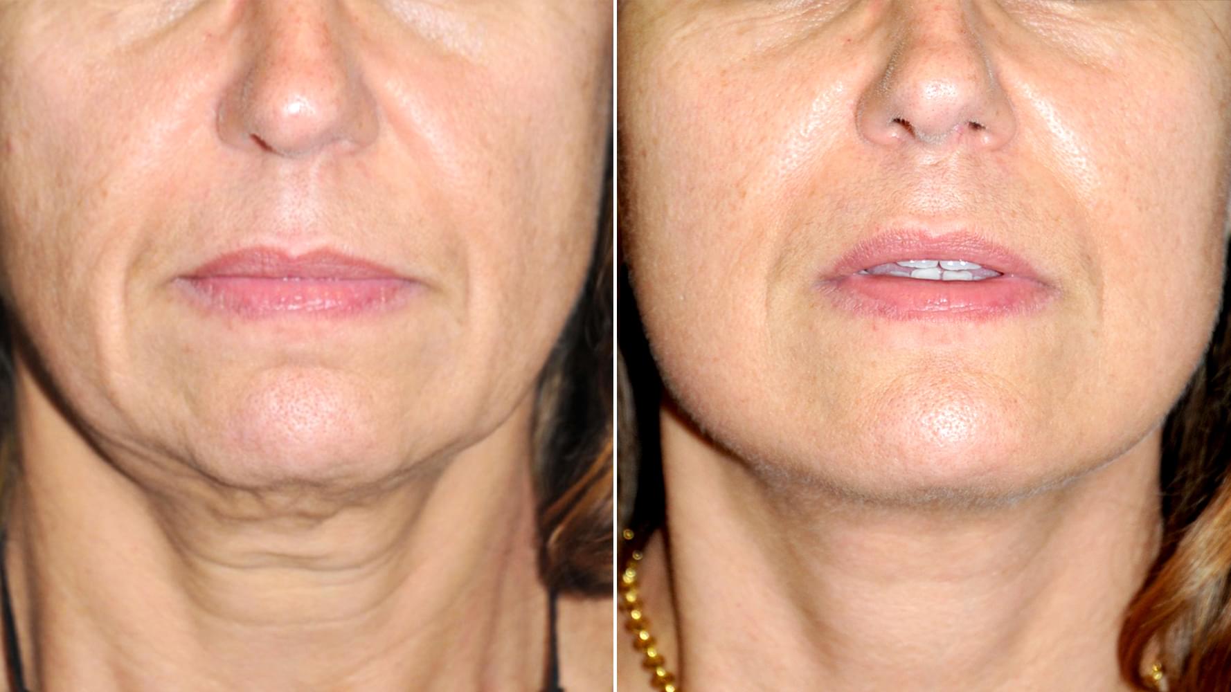 Antes e depois Micro-lift