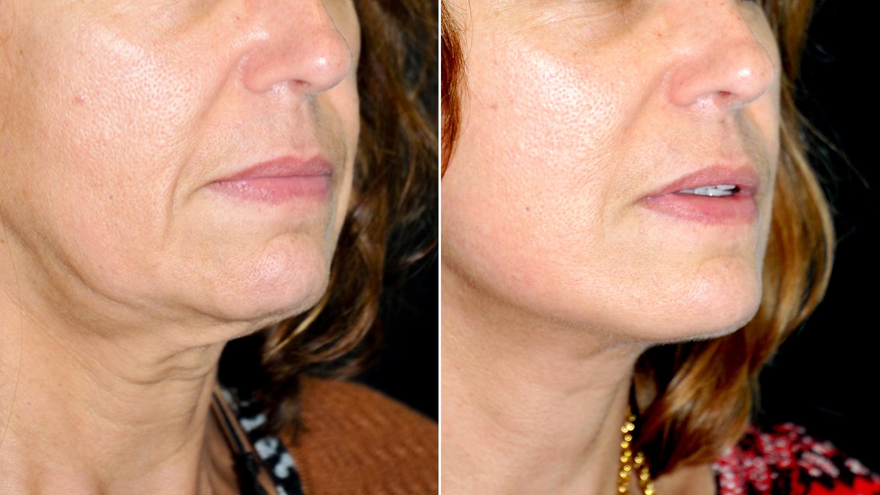 Antes e depois Micro-lift
