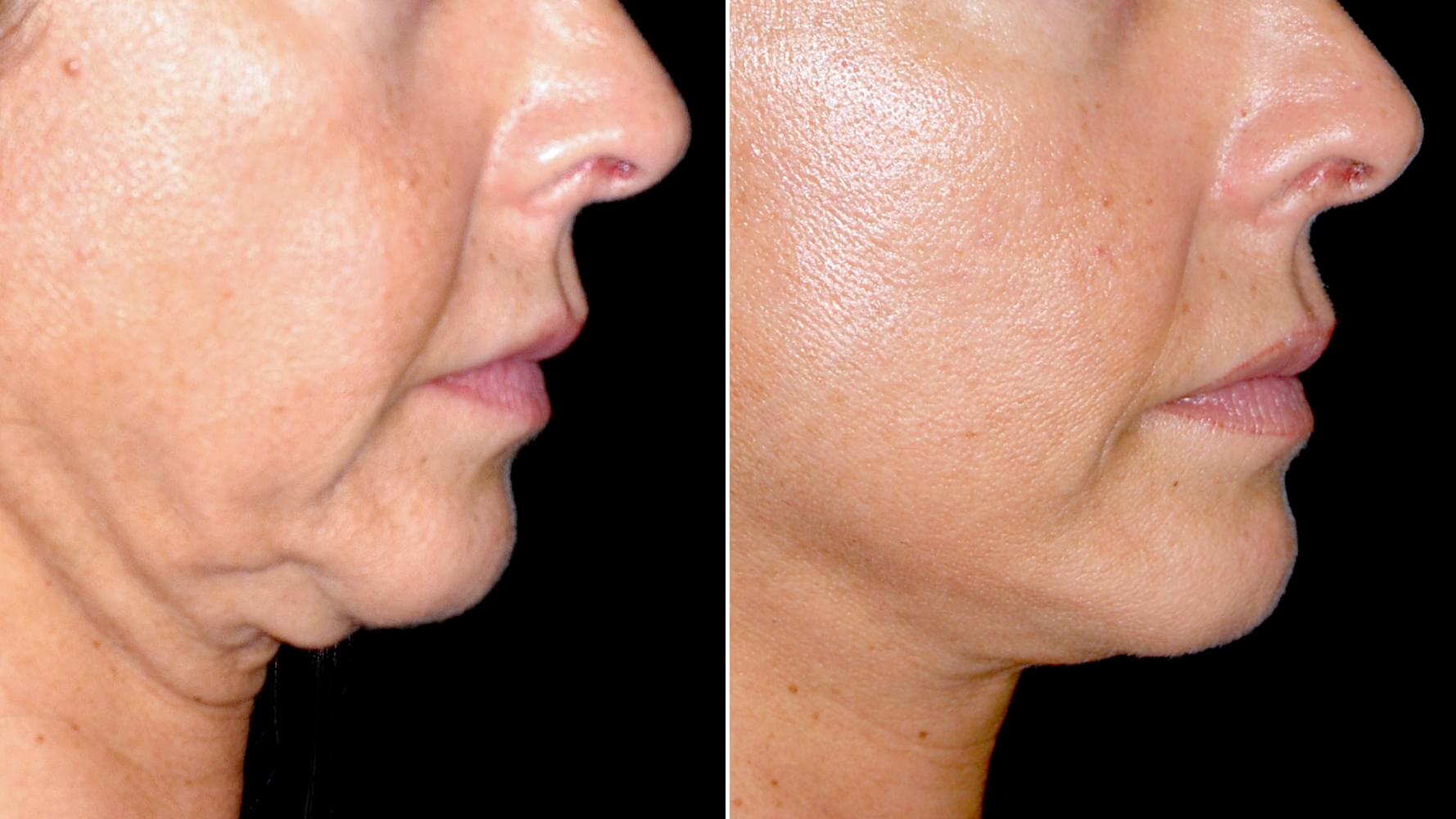 Antes e depois Micro-lift