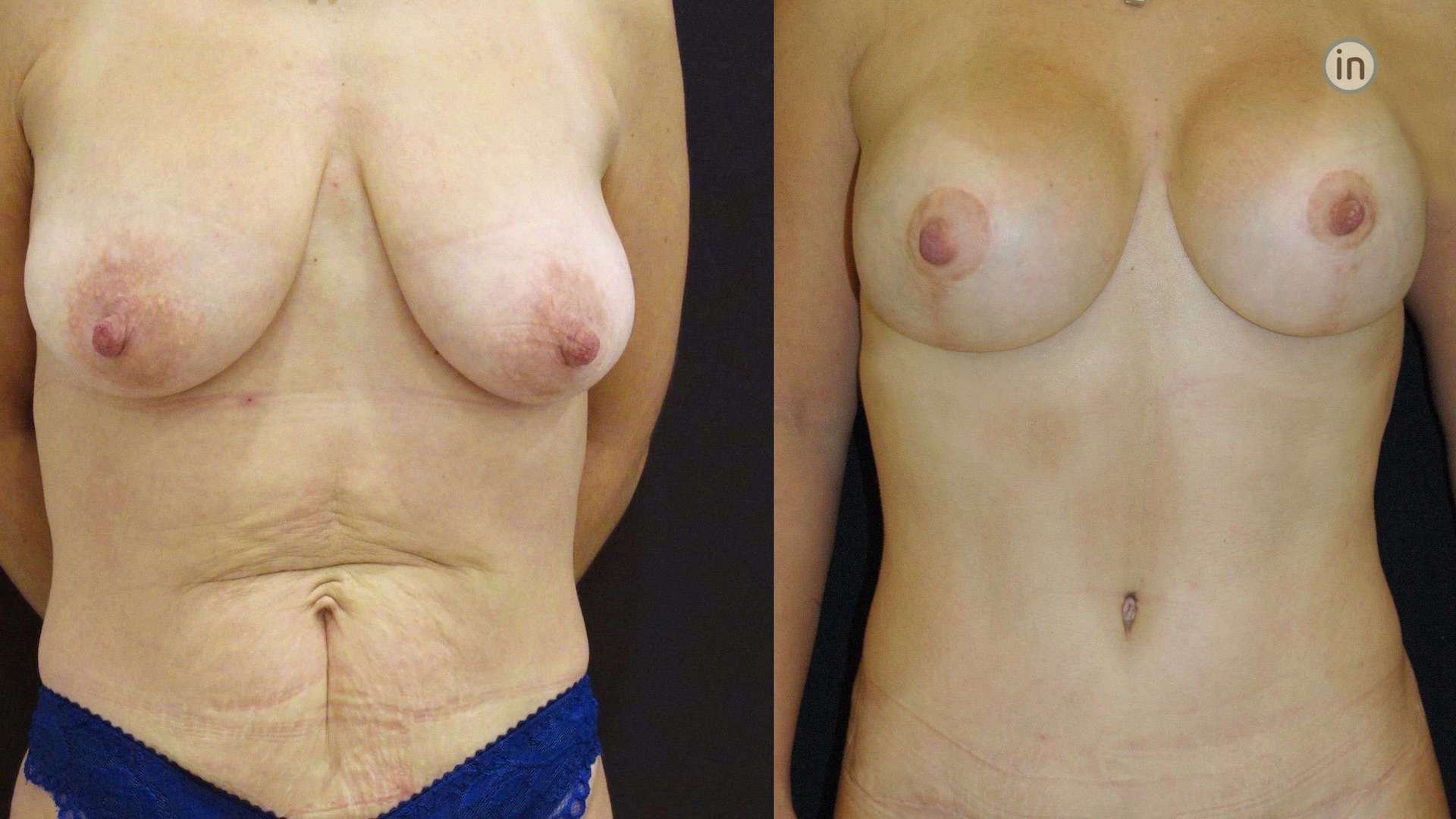 Antes e depois abdominoplastia