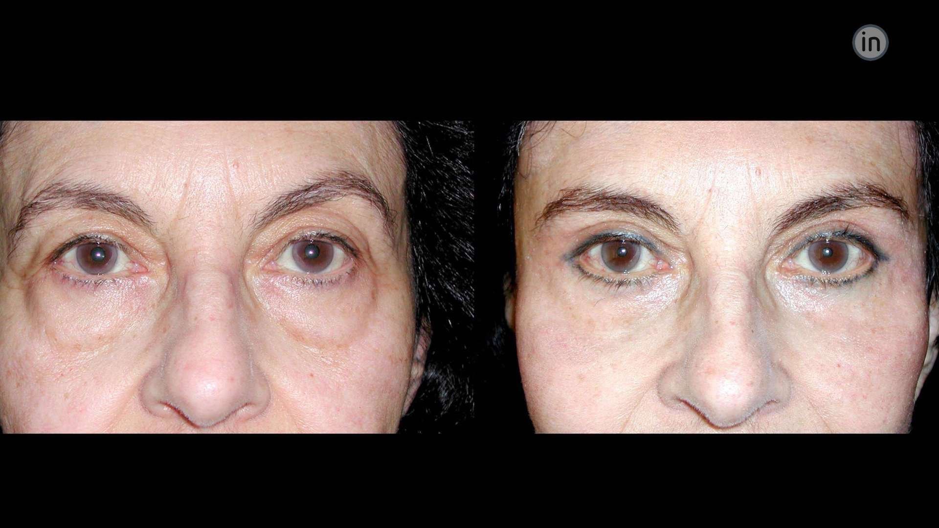 Antes e depois blefaroplastia e lift temporal