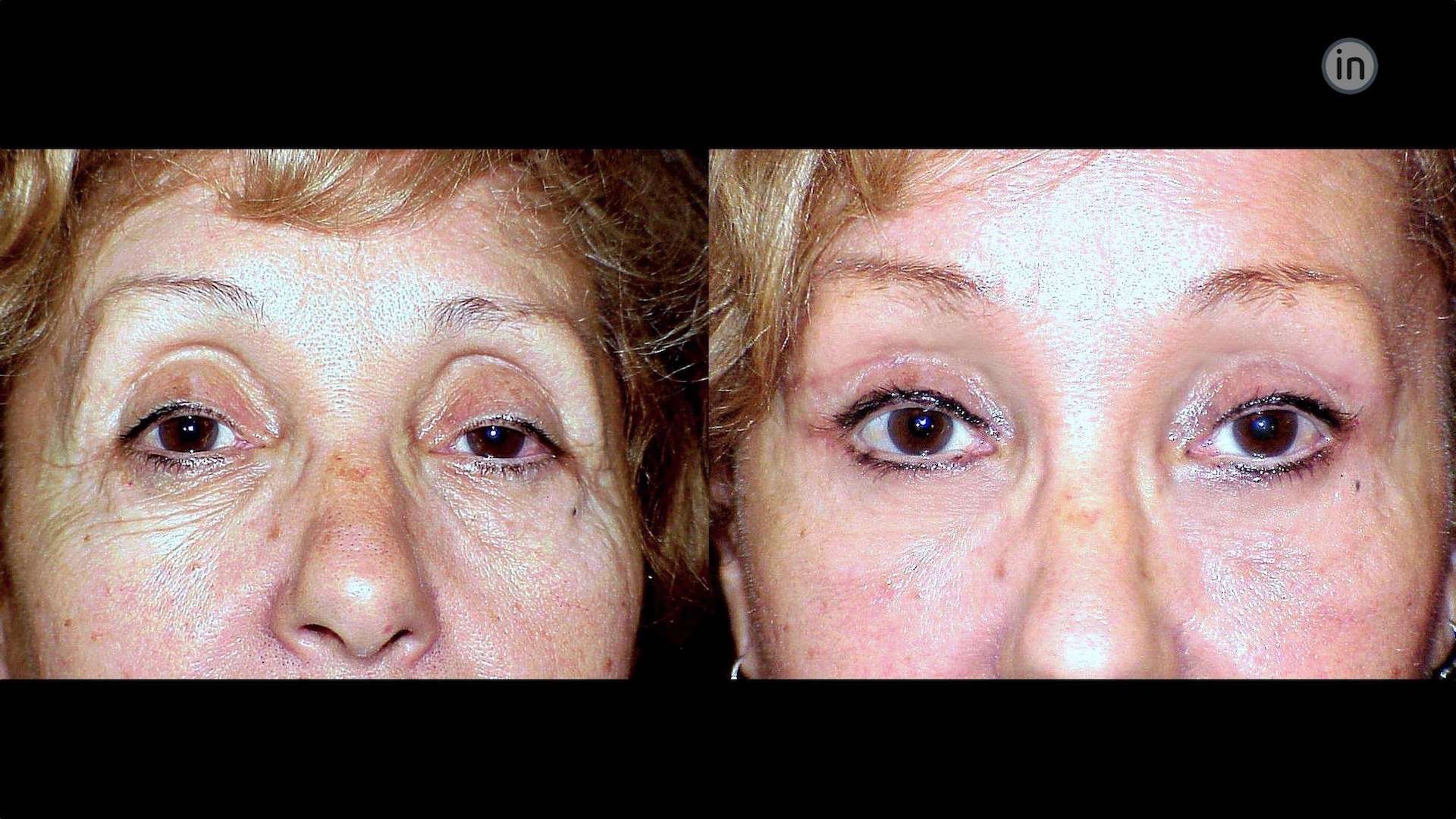 Antes e depois blefaroplastia e lift temporal