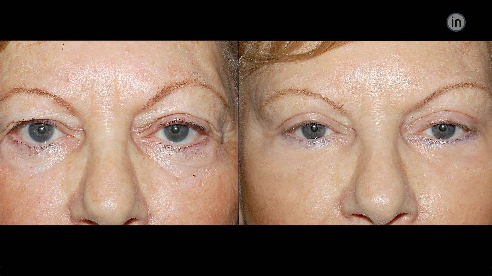 Antes e depois blefaroplastia e lift temporal