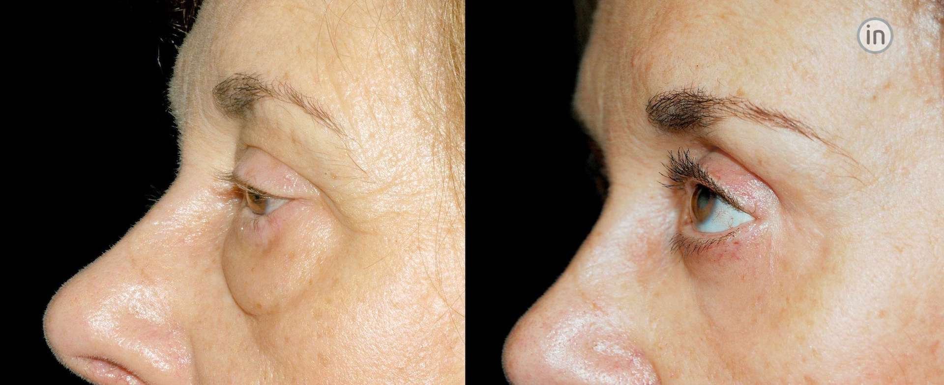 Antes e depois blefaroplastia e lift temporal