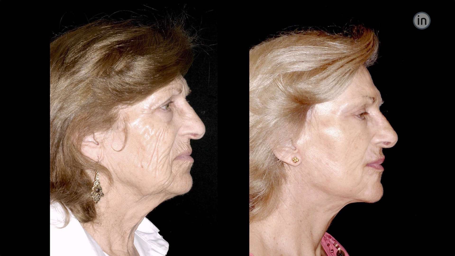 Antes e depois Facelift