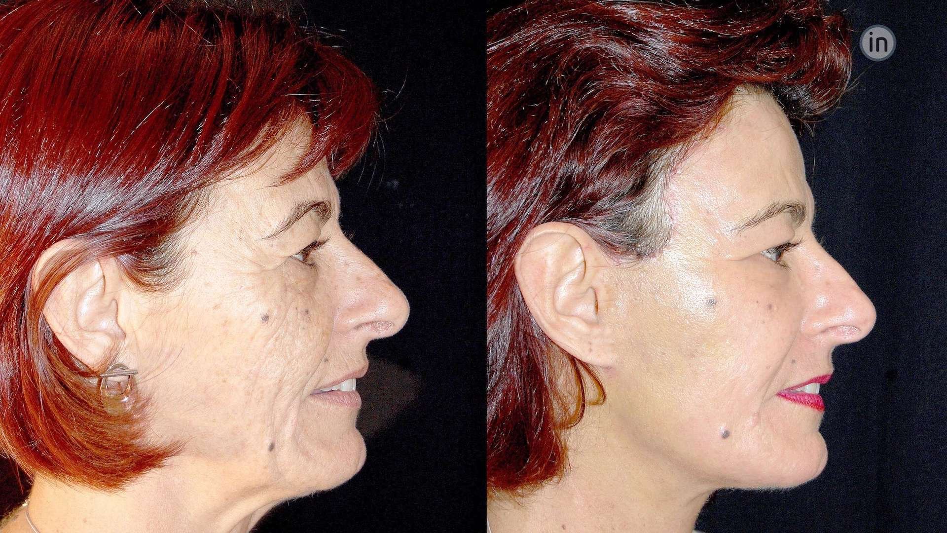Before And After Photos Face Lift