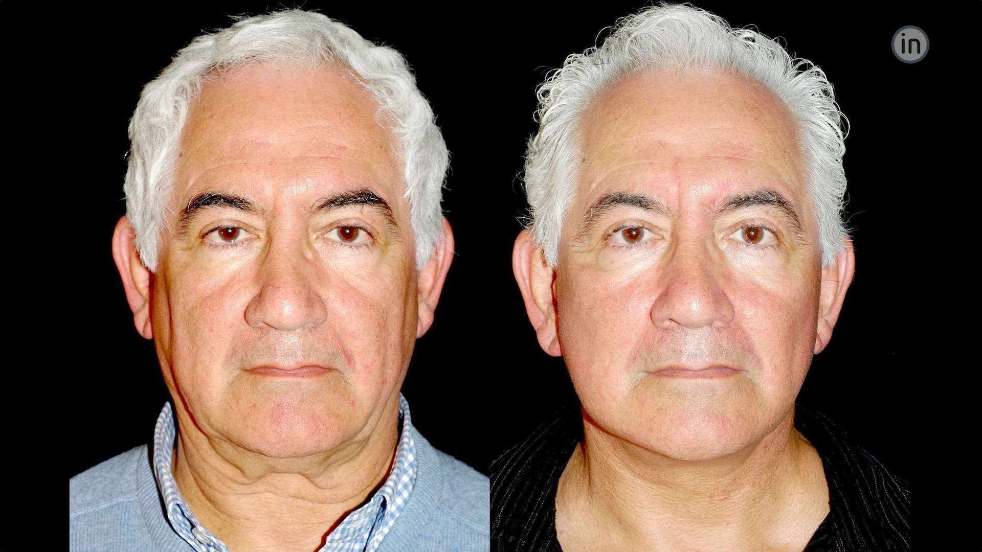 Antes e depois Facelift