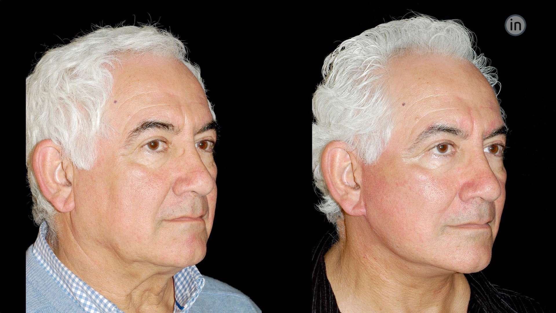 Antes e depois Facelift