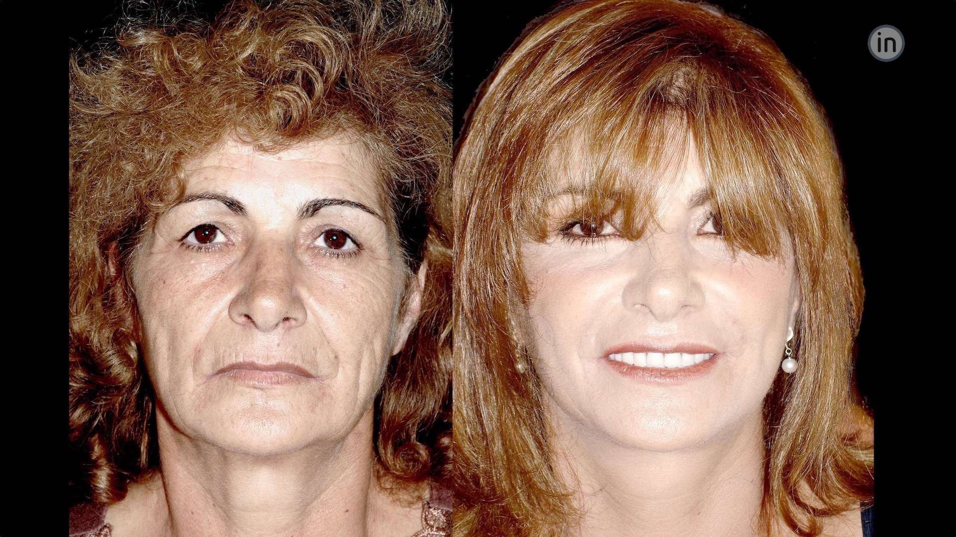 Antes e depois Facelift