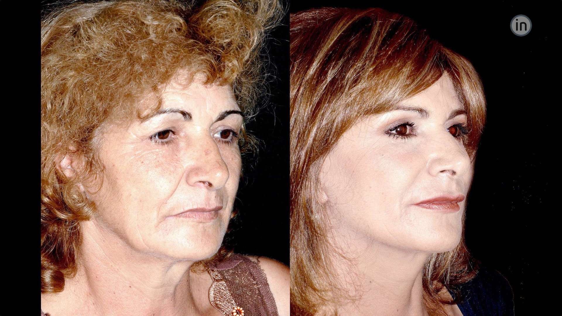 Antes e depois Facelift
