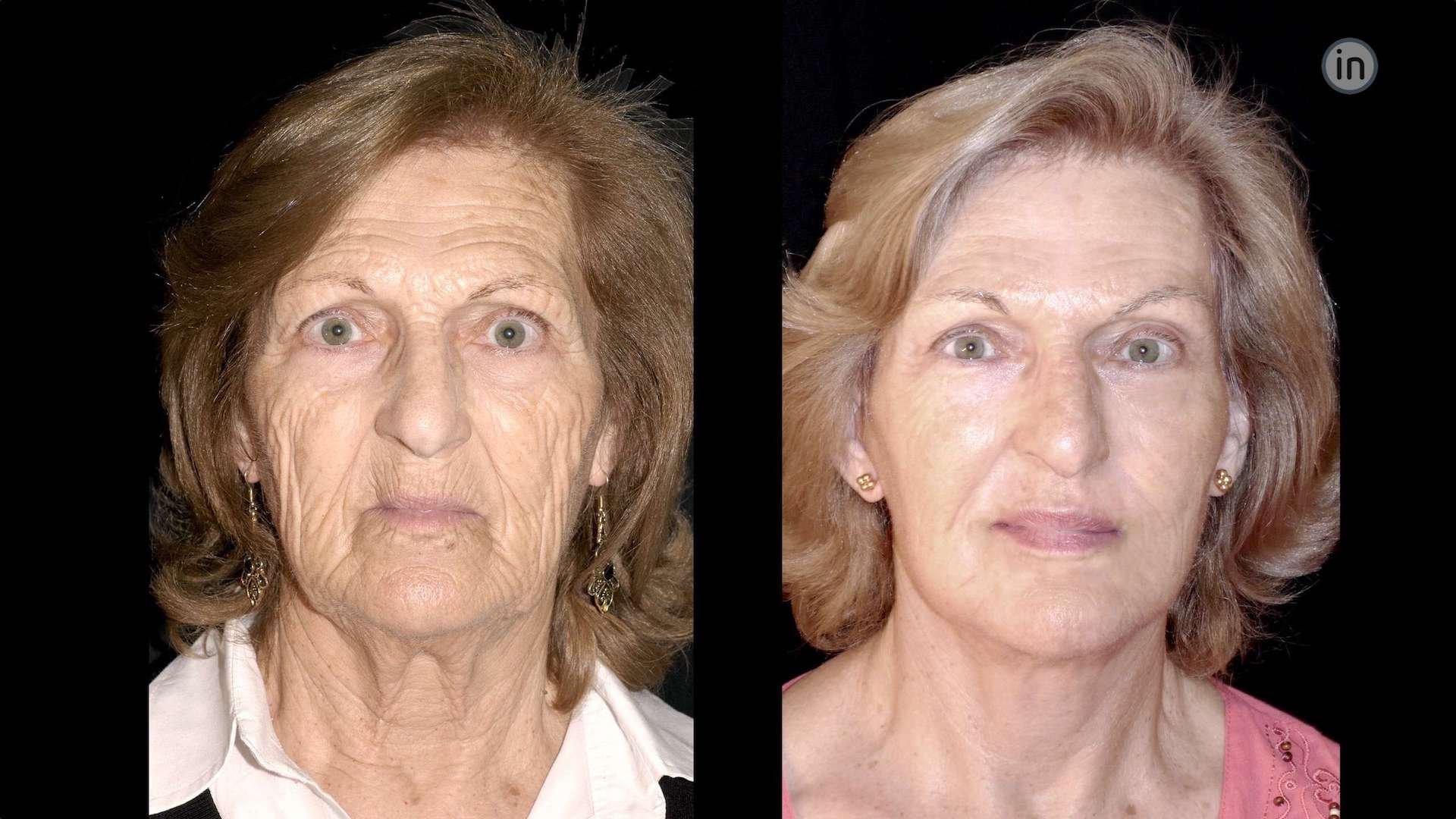 Antes e depois Facelift