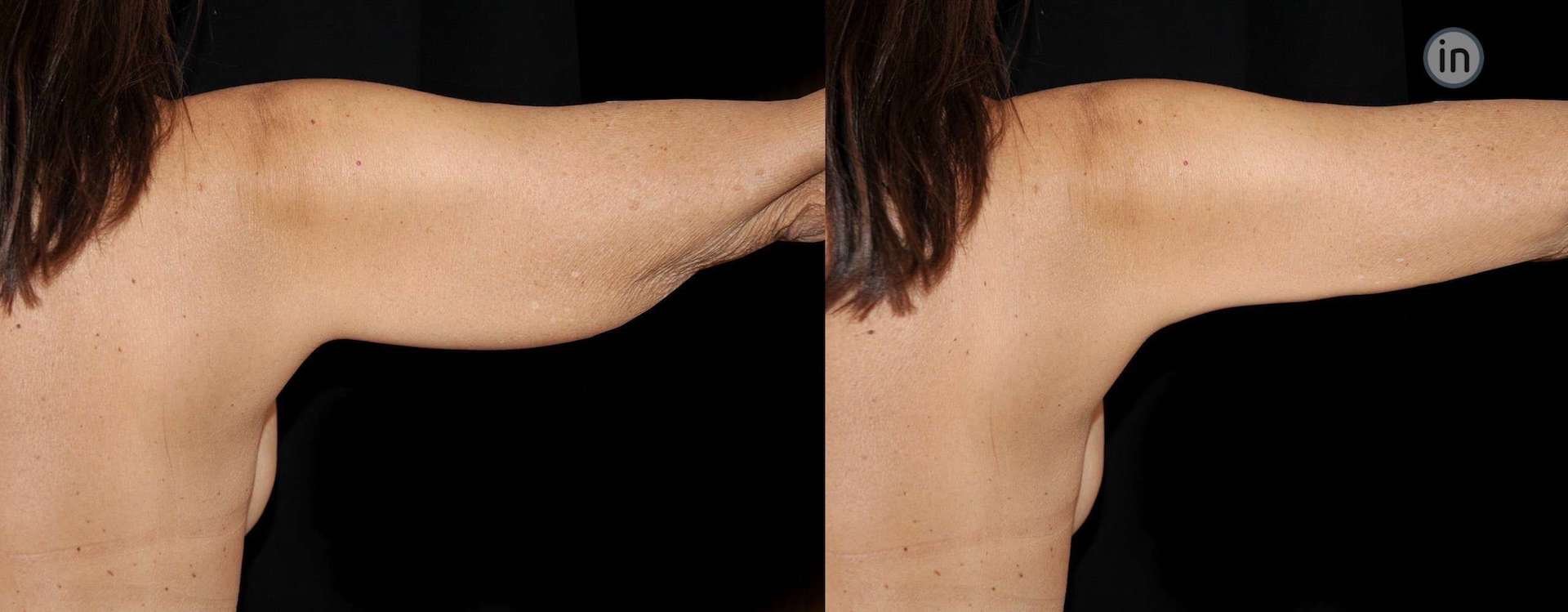 Antes e depois lift de braços