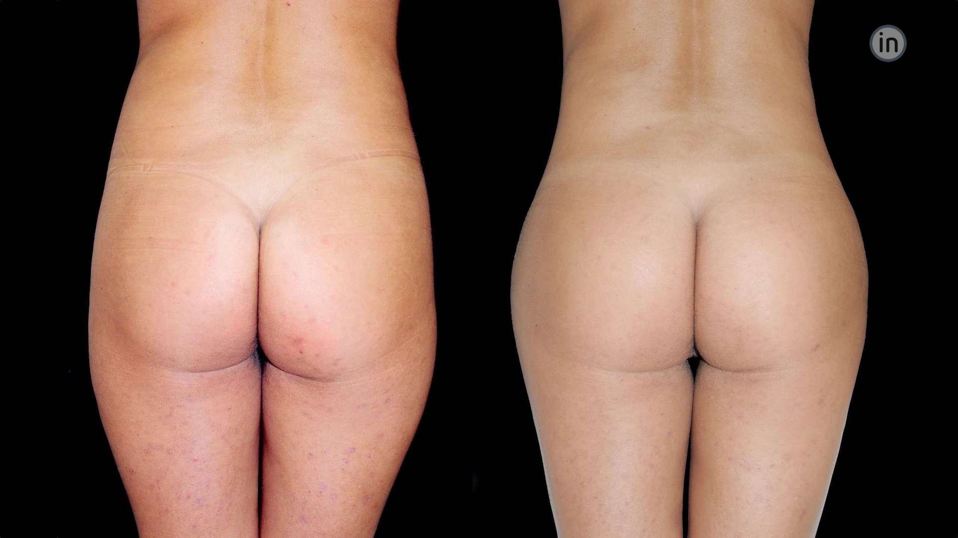 Antes e depois lipoaspiração com glúteos