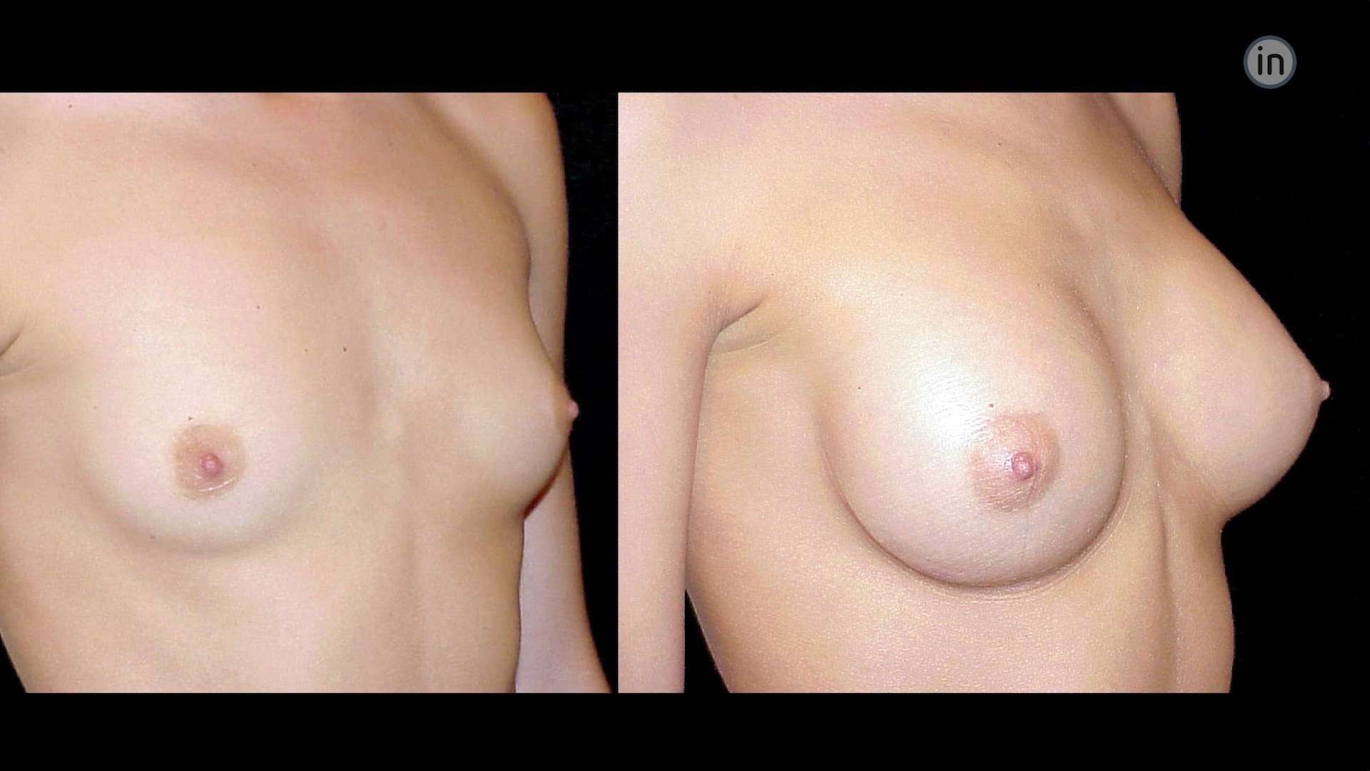 Antes e depois mamoplastia de aumento