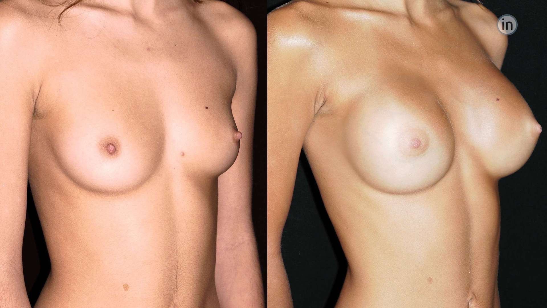 Antes e depois mamoplastia de aumento
