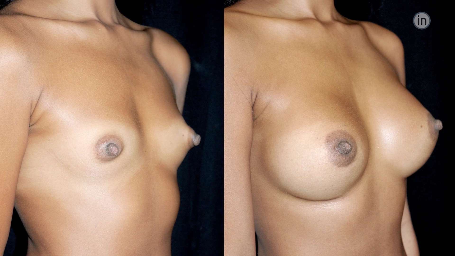 Antes e depois mamoplastia de aumento