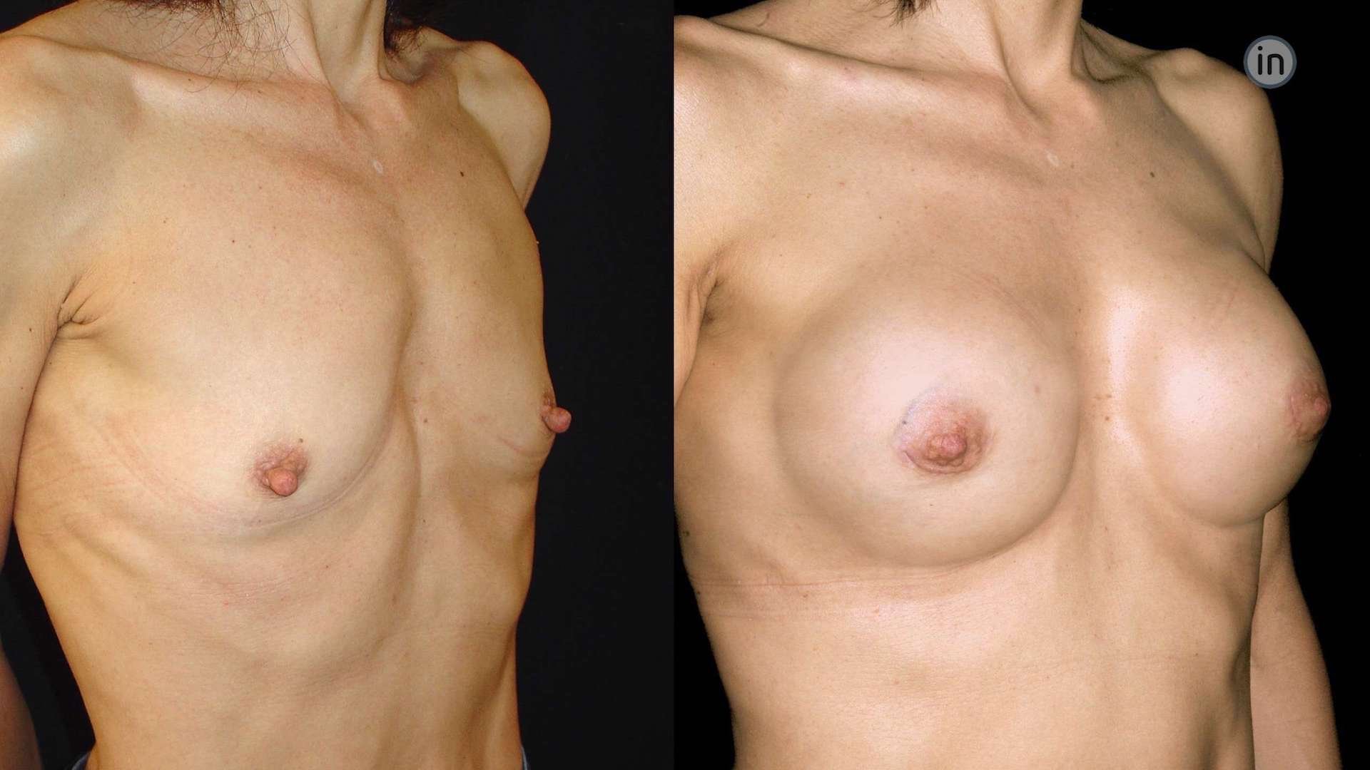 Antes e depois mamoplastia de aumento