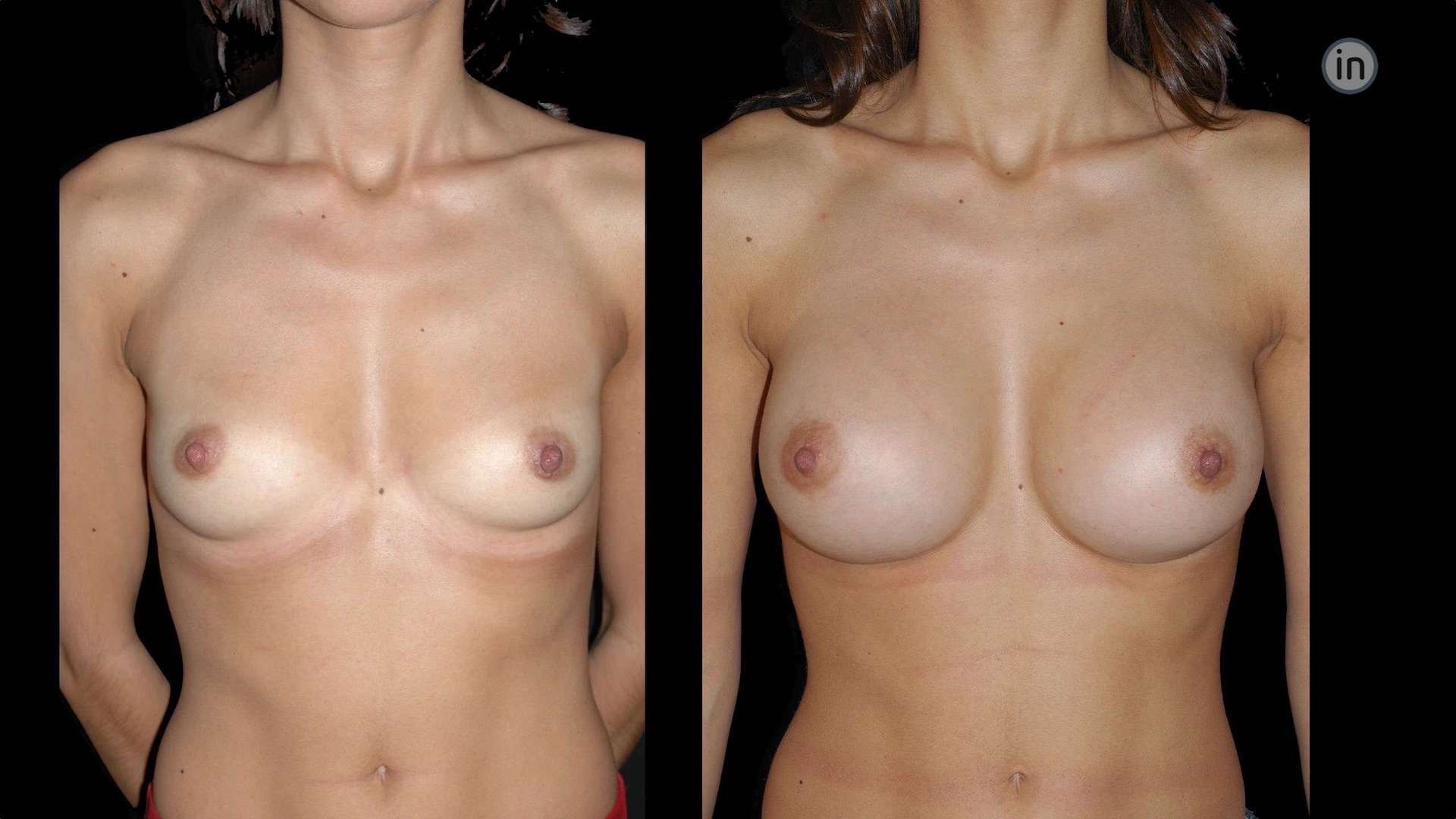 Antes e depois mamoplastia de aumento