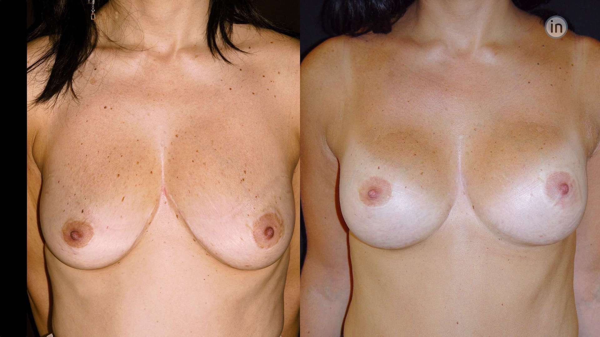 Antes e depois mastopexia com proteses