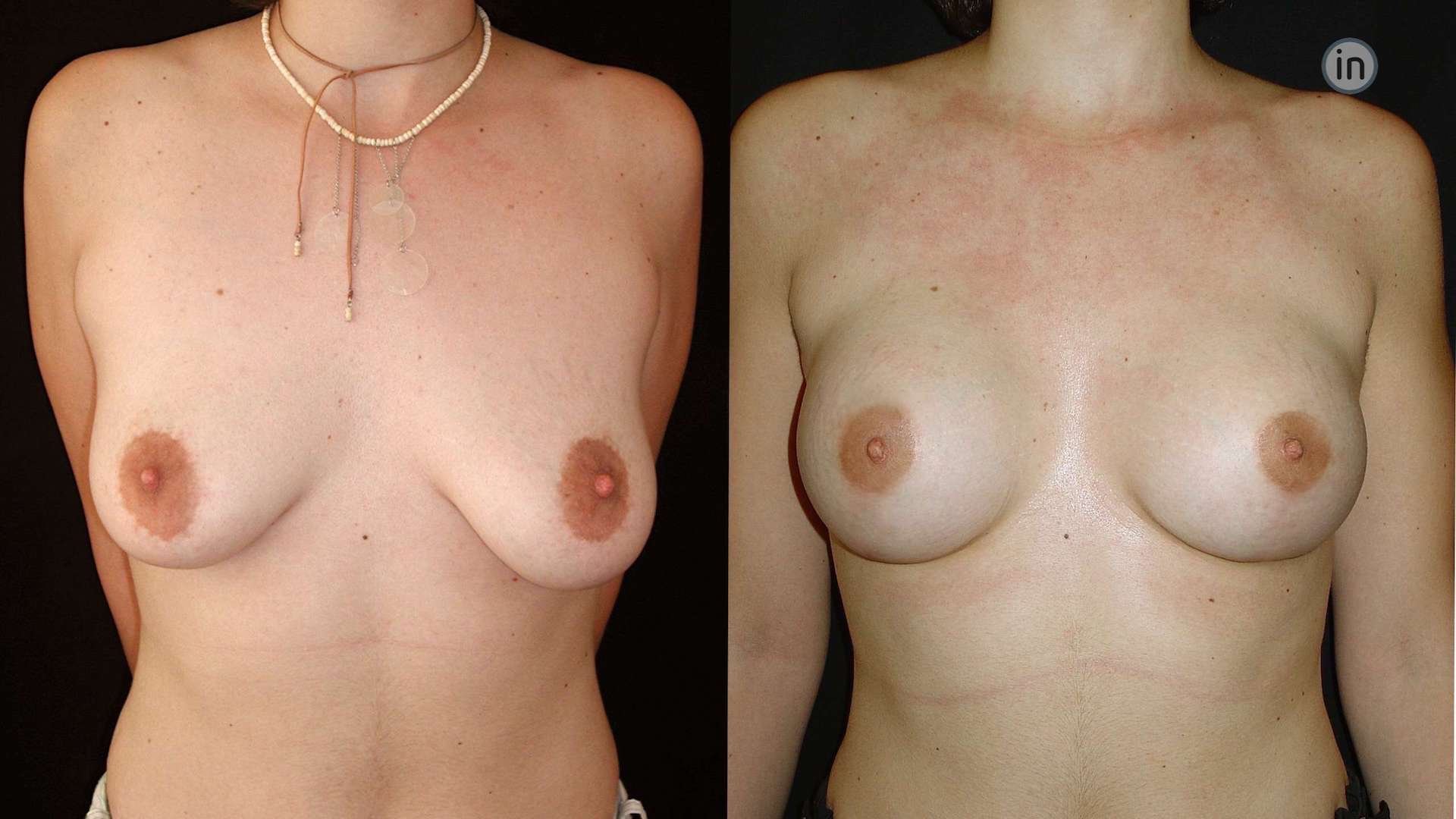 Antes e depois mastopexia com proteses