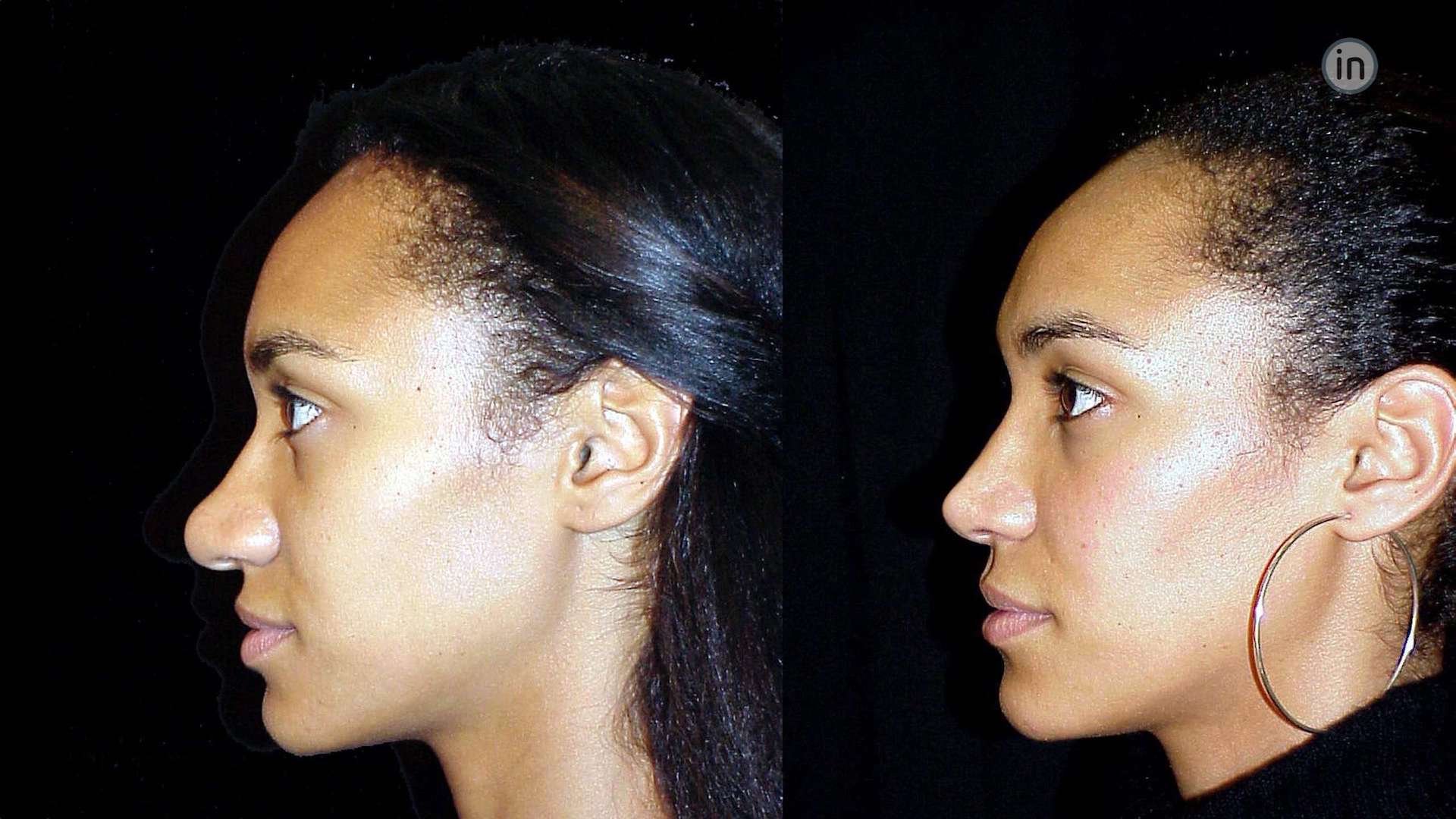 Antes e depois rinoplastia