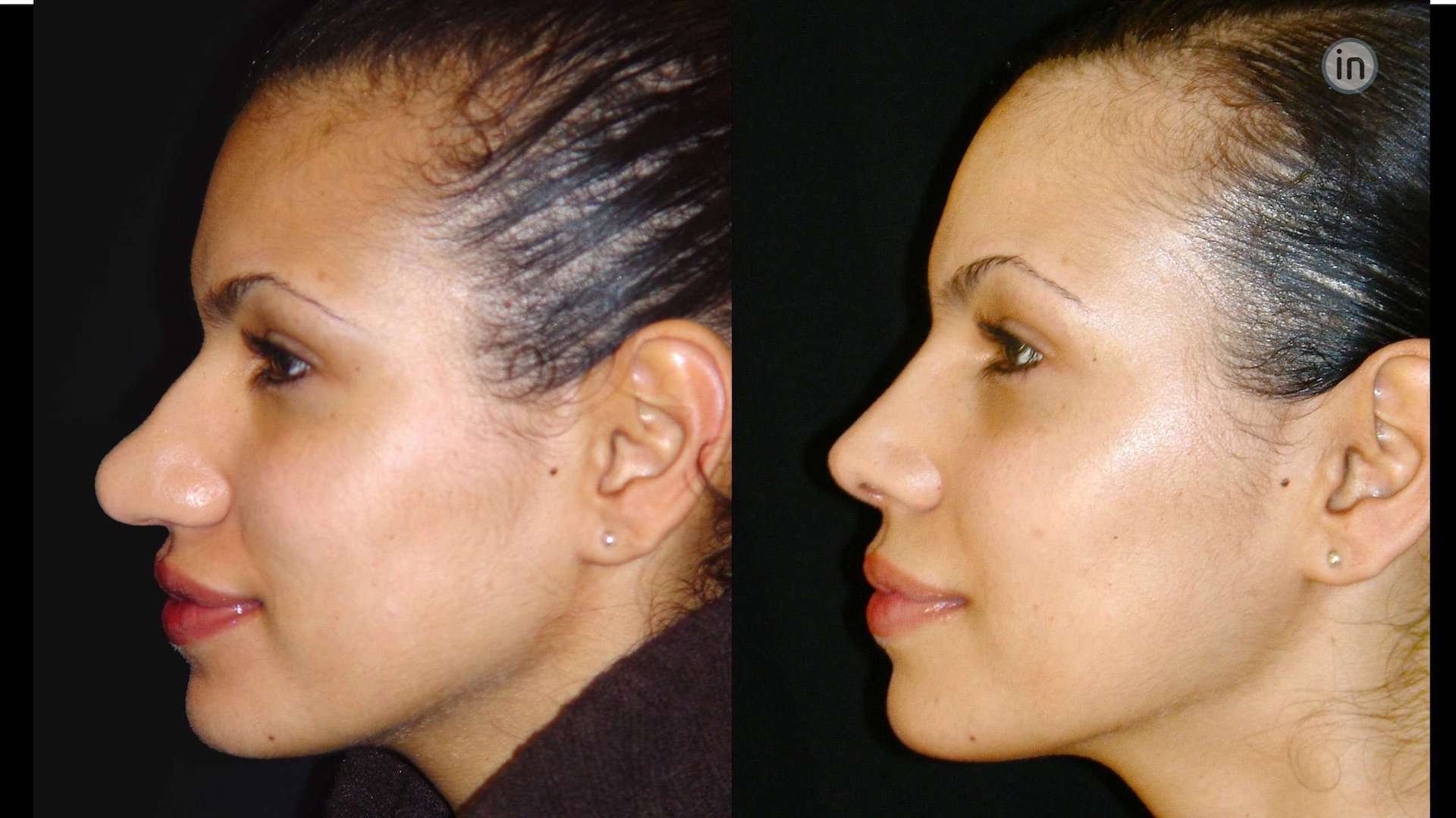 Rinoplastia Antes E Depois 2648