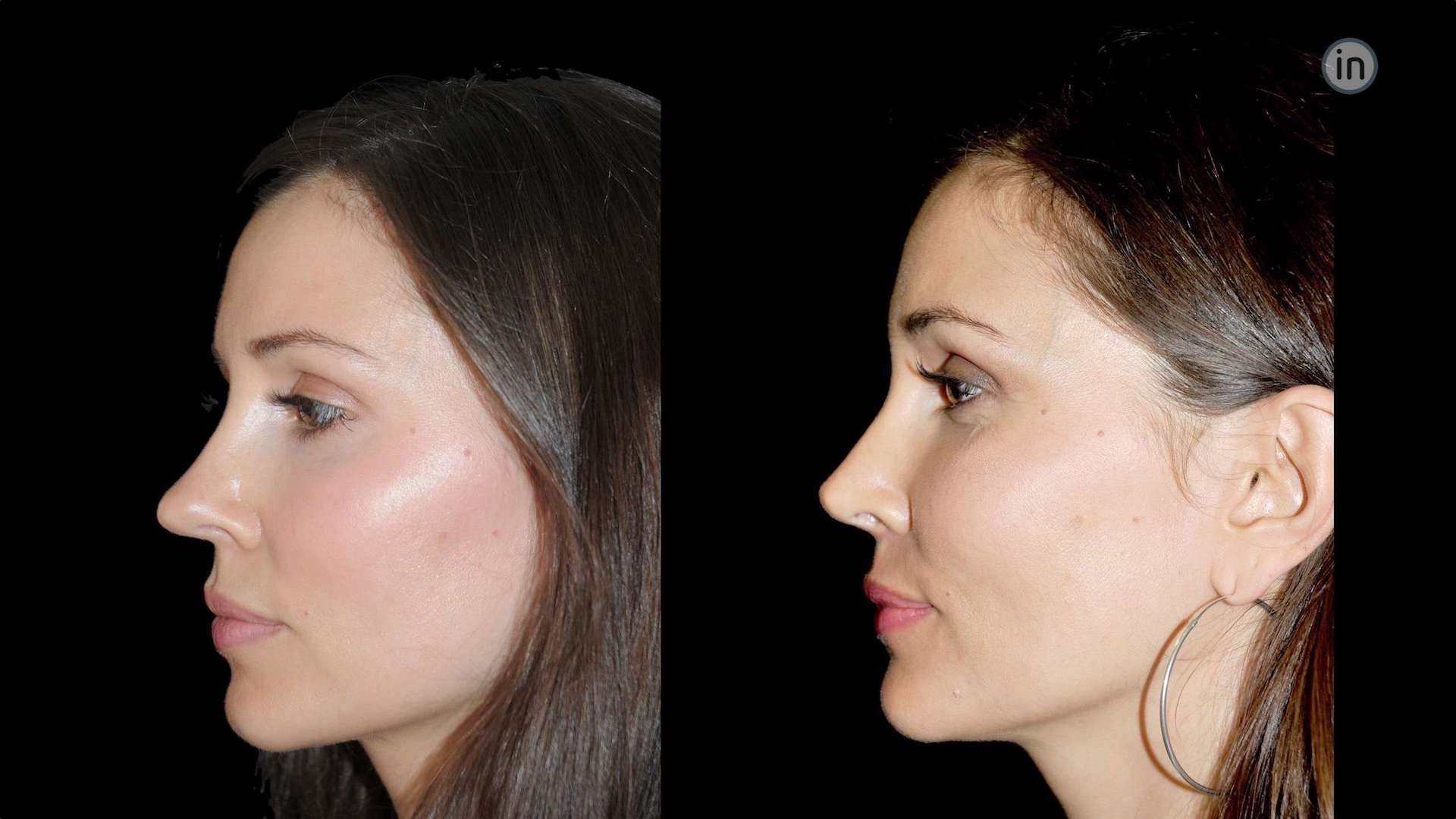 Antes e depois rinoplastia
