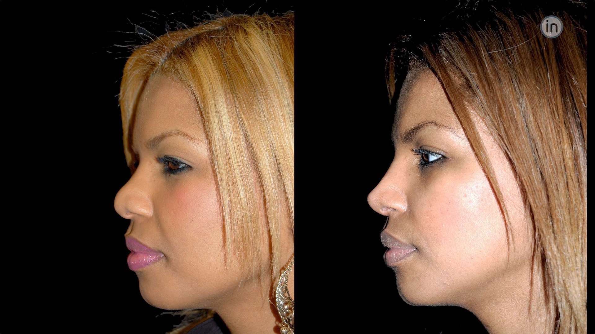 Antes e depois rinoplastia