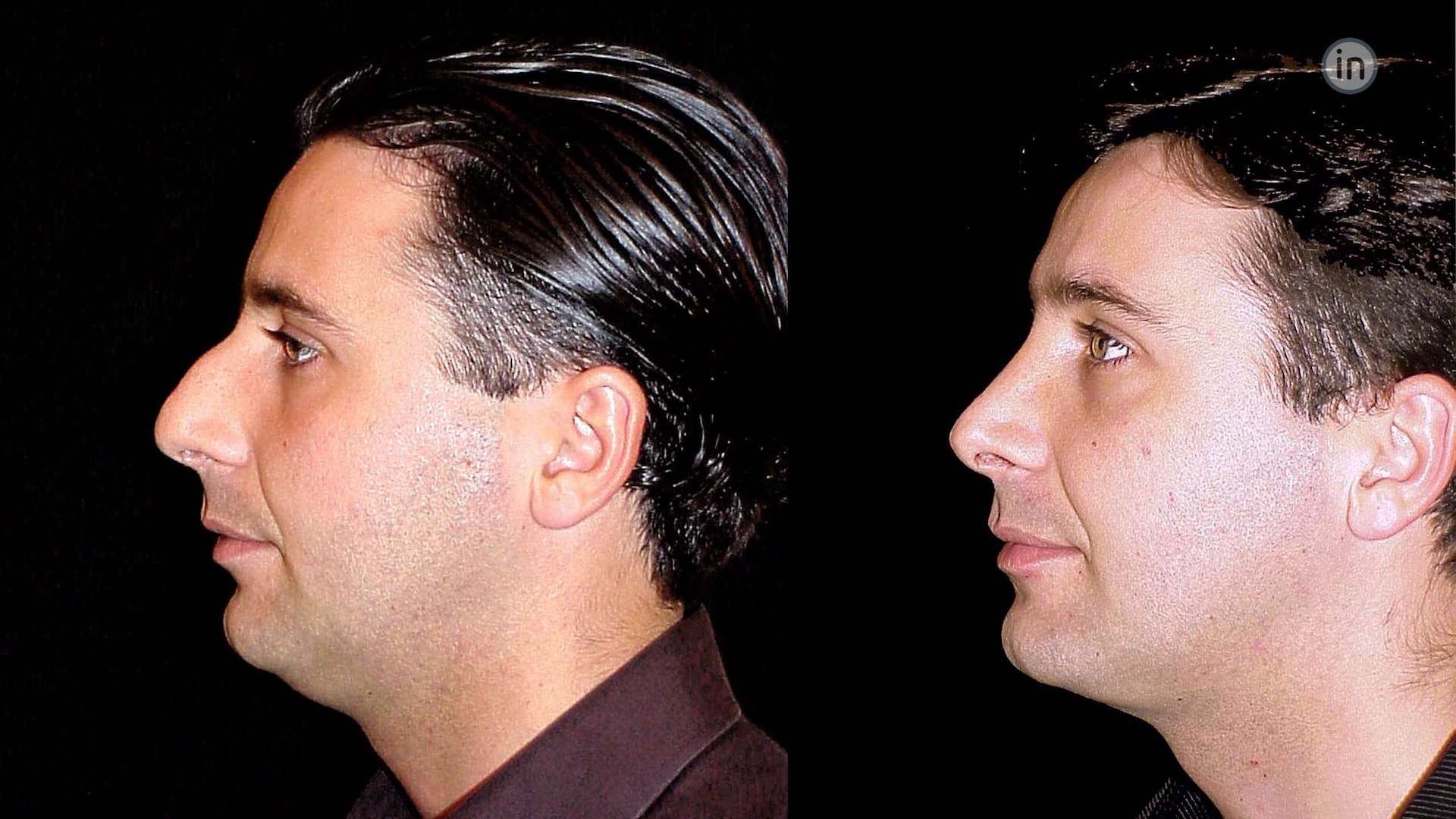 Antes e depois rinoplastia