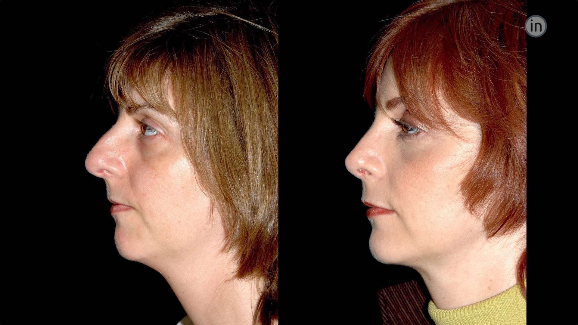 Antes e depois rinoplastia e mentoplastia