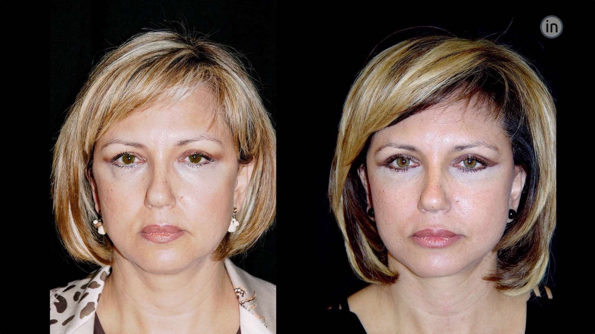 Antes e depois soft-lift
