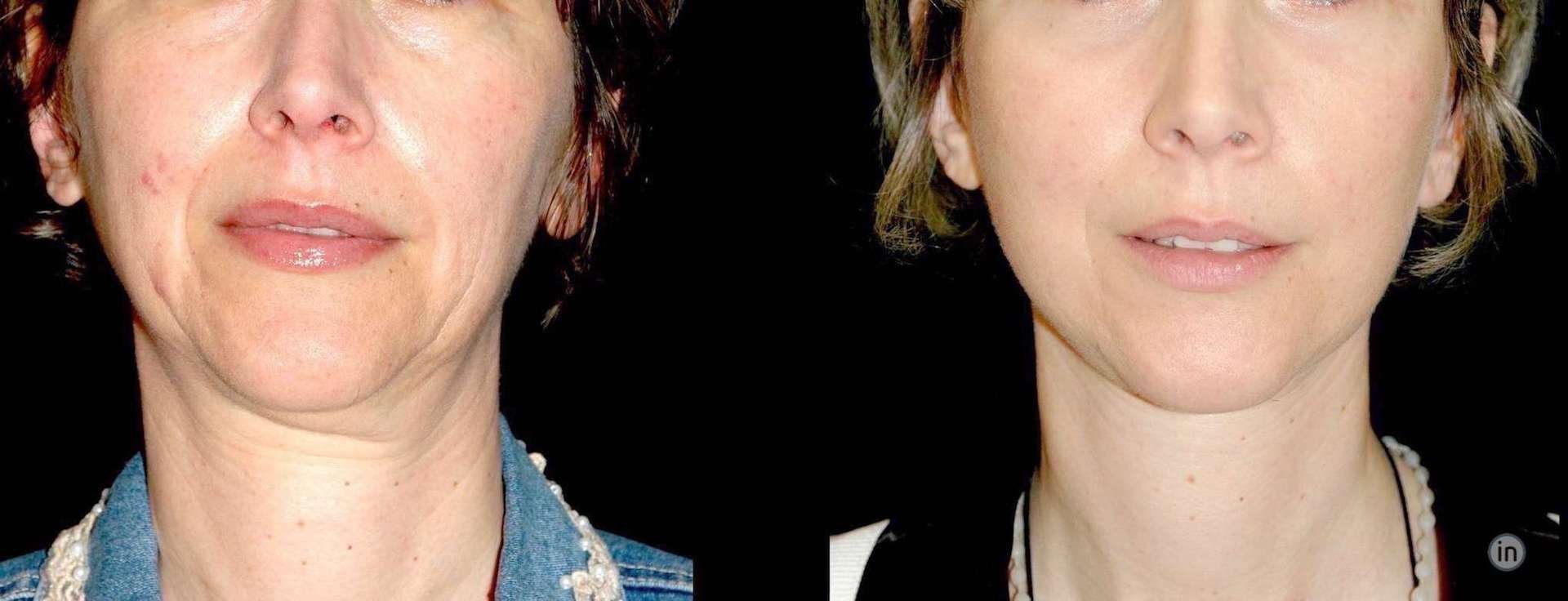 Antes e depois soft-lift