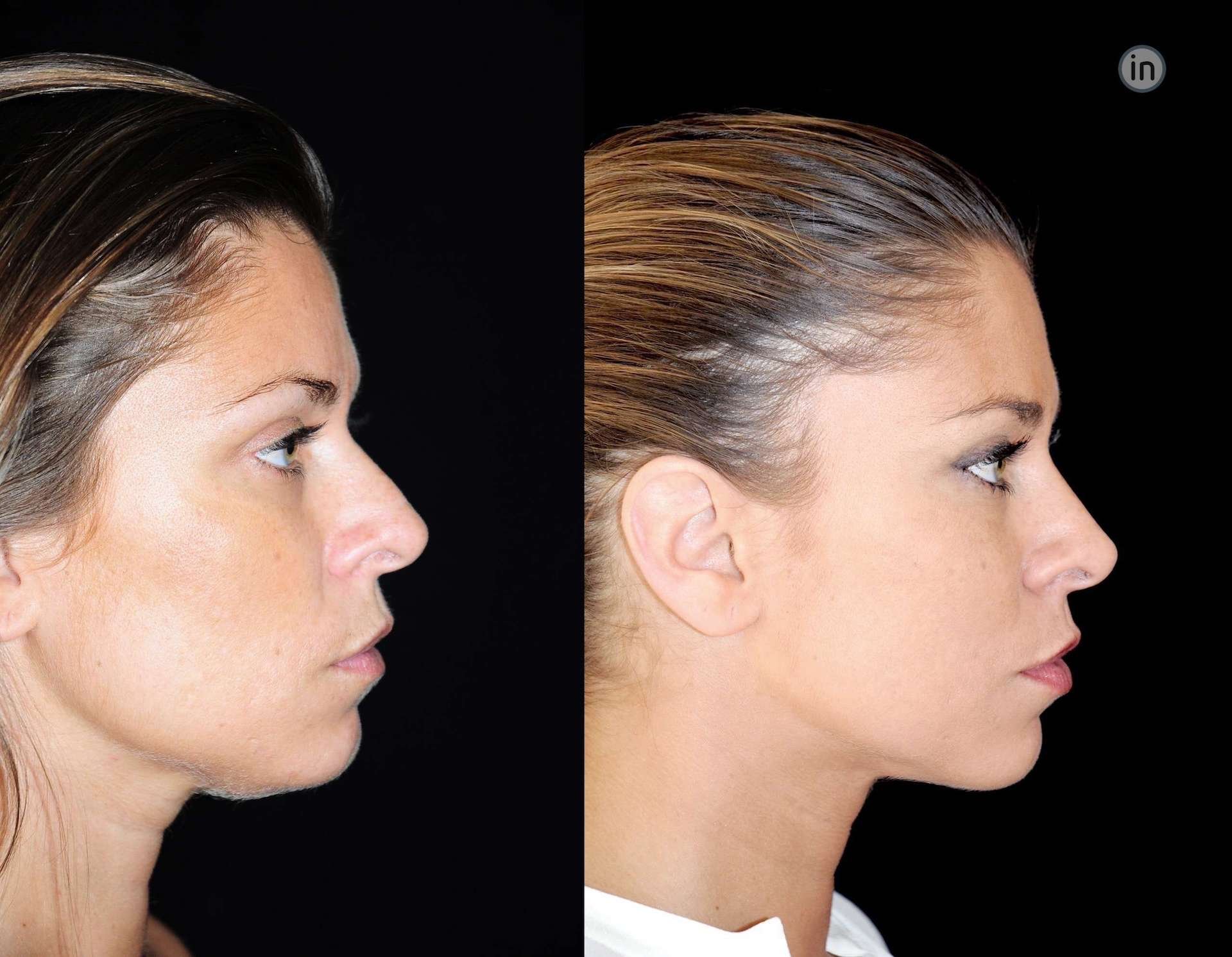 Antes e depois soft-lift