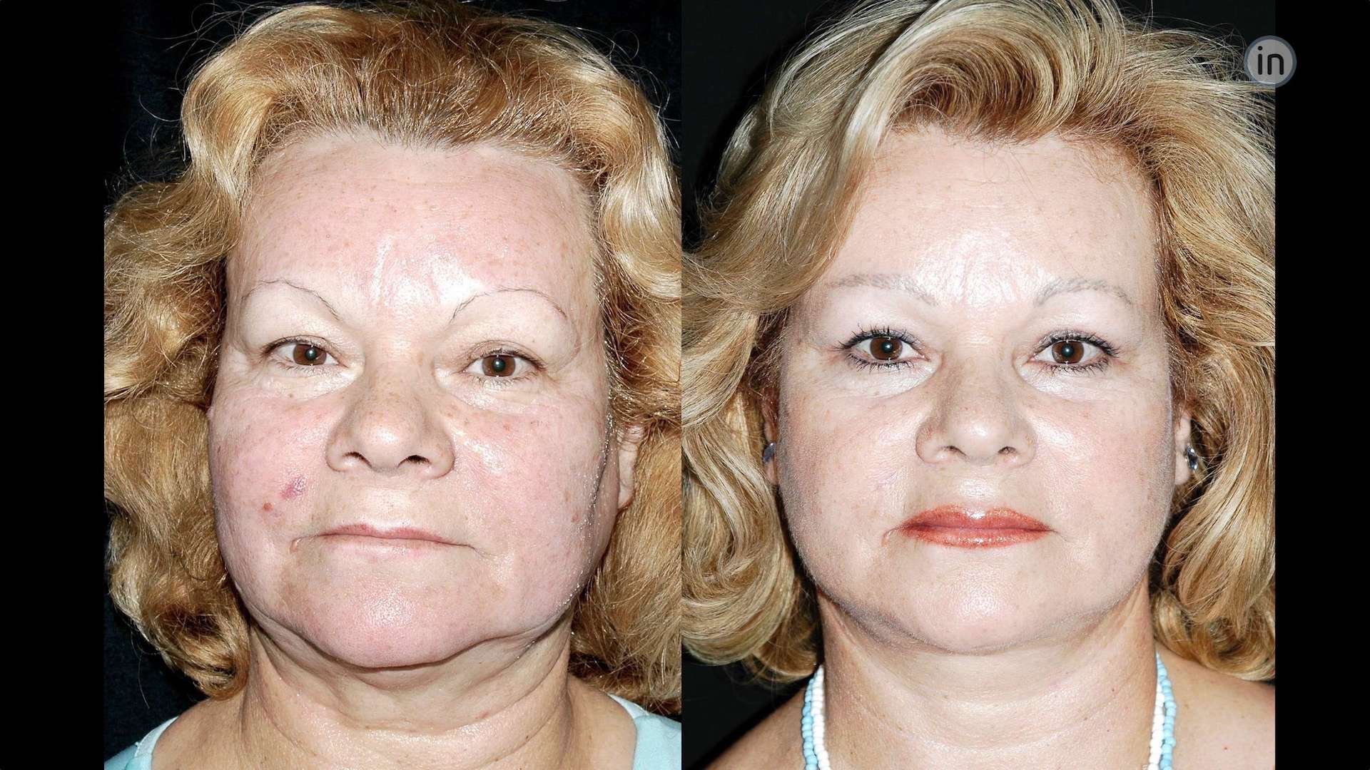 Antes e depois soft-lift